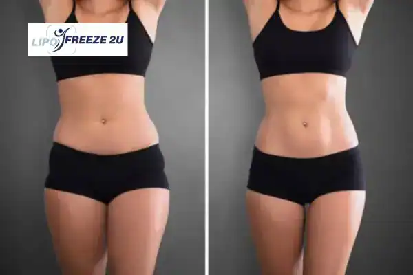 How Can LIPO FREEZE 2U Support Your Post-Pregnancy Body Recovery Buckinghamshire?