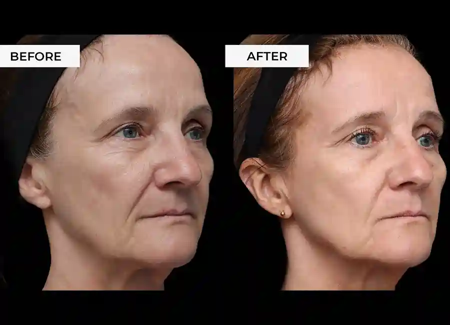 How Many RF Microneedling Sessions Will You Need to See a Difference Buckinghamshire?