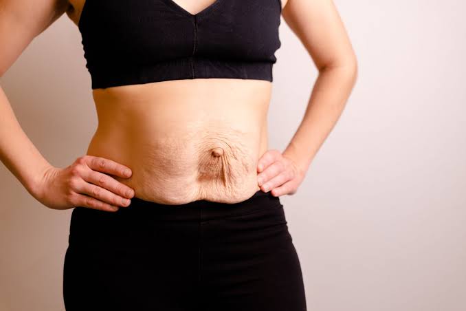 Is Surgery Really the Only Way to Repair Diastasis Recti Buckinghamshire?