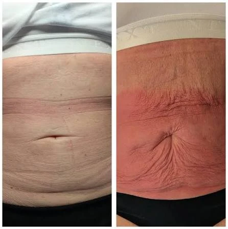 How Does RF Microneedling Improve Crepey, Thin and Uneven Skin Texture Buckinghamshire?