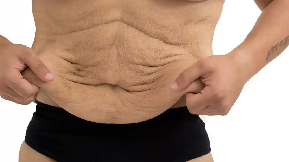 Why Does Weight Loss Medication Leave Some People With Loose or Sagging Skin Buckinghamshire?